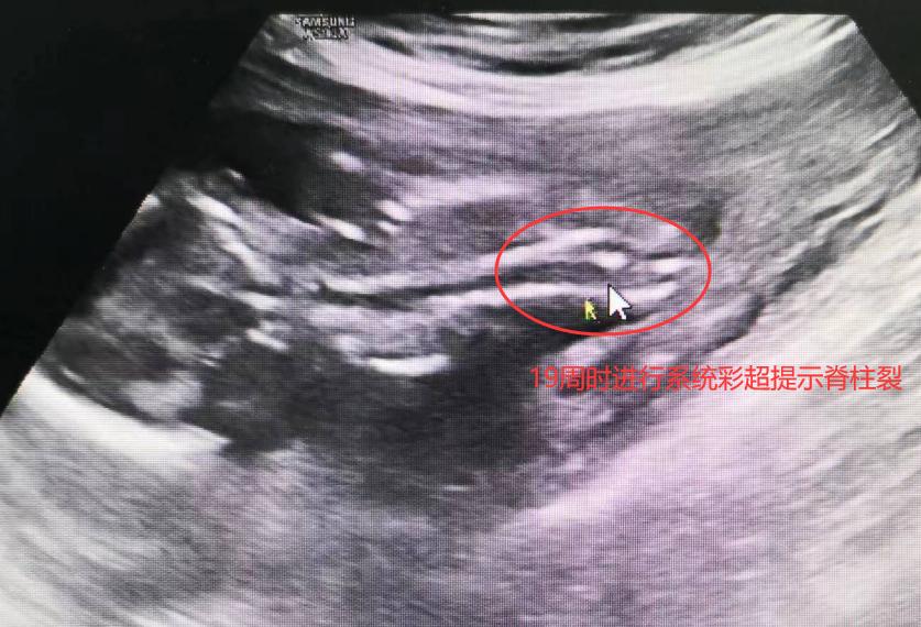 双胎先天性畸形概率,双胎一个畸形可以足月减胎吗