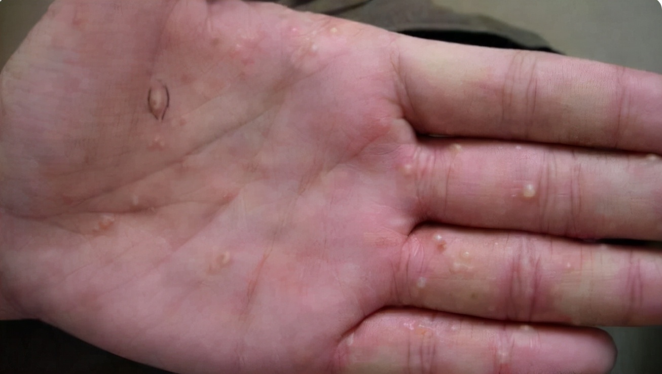 手上起小水泡很痒应该抹什么药膏,手上起小水泡又痒又疼怎么办