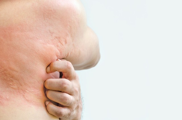 荨麻疹原因及中医治疗方法,荨麻疹中医怎么治疗最有效