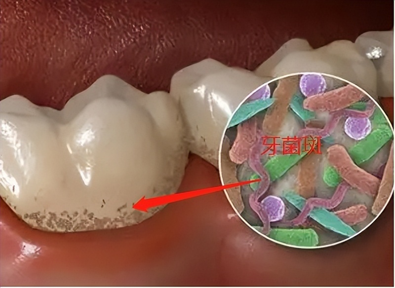 拔牙之后怎么护理口腔,拔牙后怎么护理记住这6点就够了