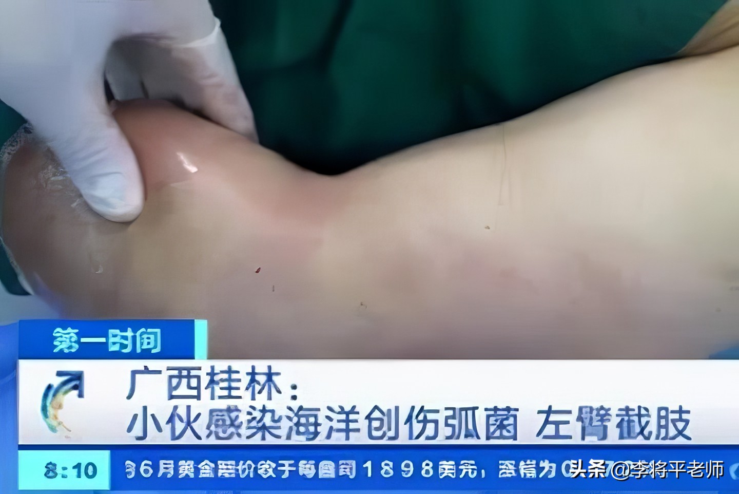 女子被河虾刺到导致截肢,被河虾扎手截肢