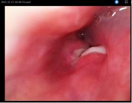 鱼刺卡喉求医6次,记录求医之路