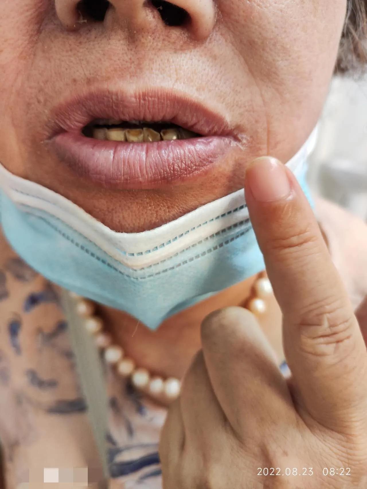 干燥综合征吃中药多久可以控制,干燥综合征喝中药可以治愈吗