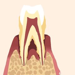 咨询医生治疗牙周炎,我想种植牙