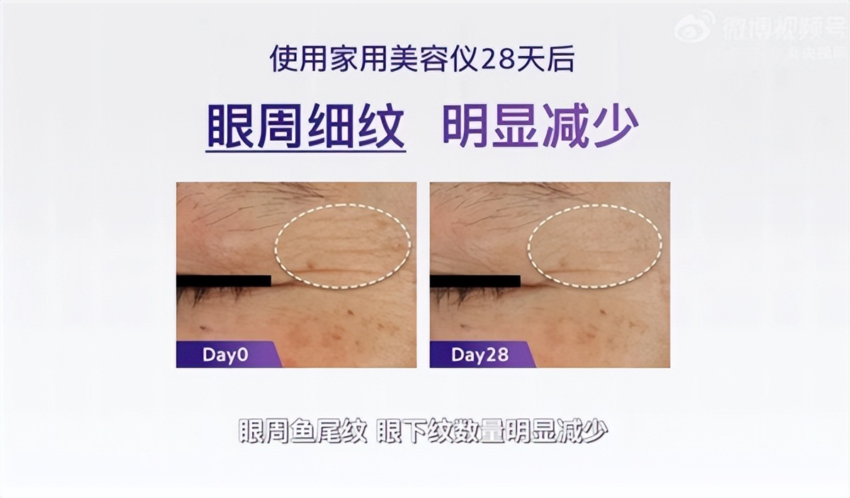 flossom花至射频仪用完要洗脸吗,flossom美容仪多少块