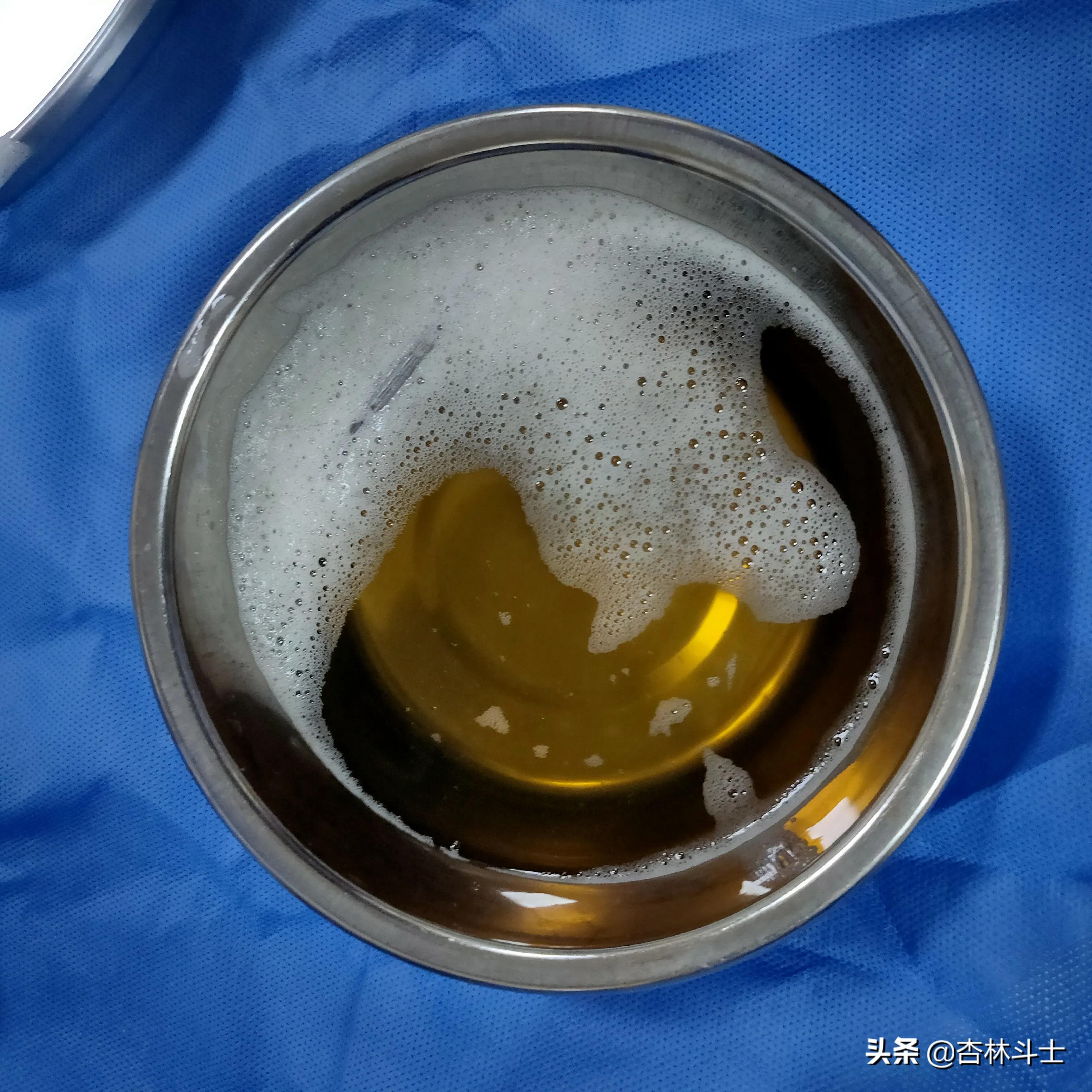 64岁银行职员患肝囊肿,CT引导下细针穿刺抽吸酒精硬化解决大问题