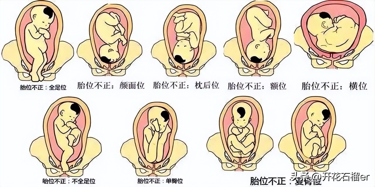仰头和低头出生的区别,婴儿仰头出生和侧身出生