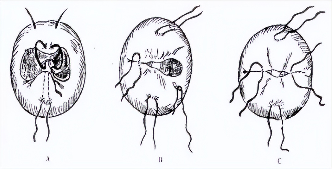 宫颈锥切手术的操作能力和技巧