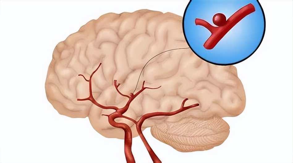 脑动脉瘤出血开颅手术,脑动脉瘤出血能治好吗