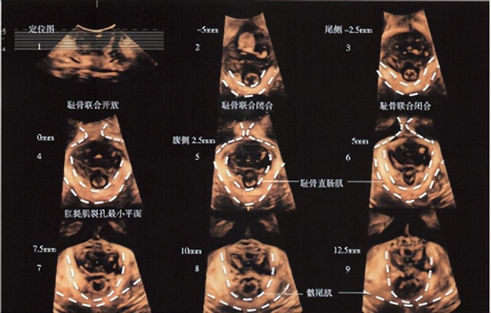 提高盆底康复知识知晓率,盆底肌肉损伤怎么治疗效果最好