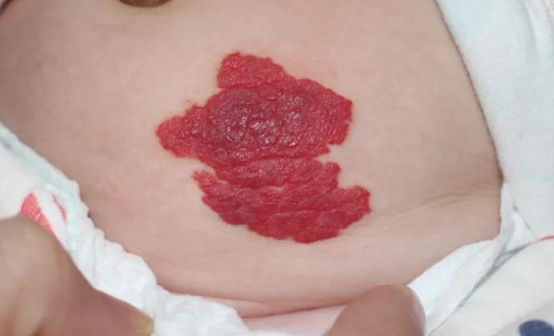 宝宝血管瘤会形成胎记,宝宝血管瘤和红胎记的区别