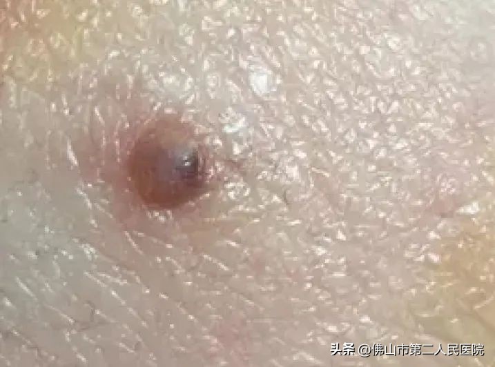 年轻歌手得黑色素瘤去世,歌手黑痣和黑色素瘤的区别