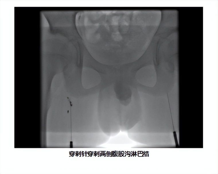 儿童淋巴管瘤的彩超表现,儿童淋巴管畸形哪里能看