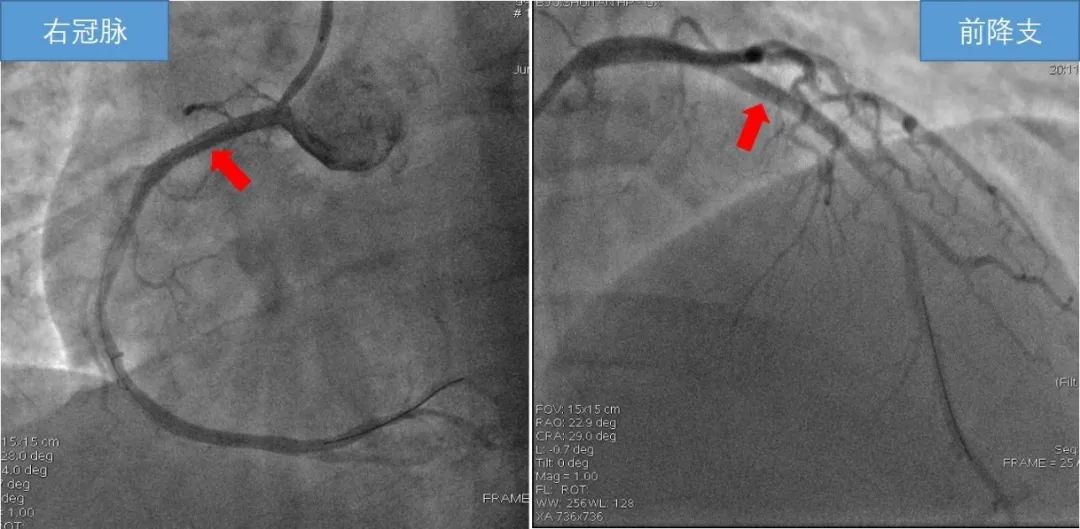 27岁壮小伙突发急性心梗,25岁小伙患急性心梗