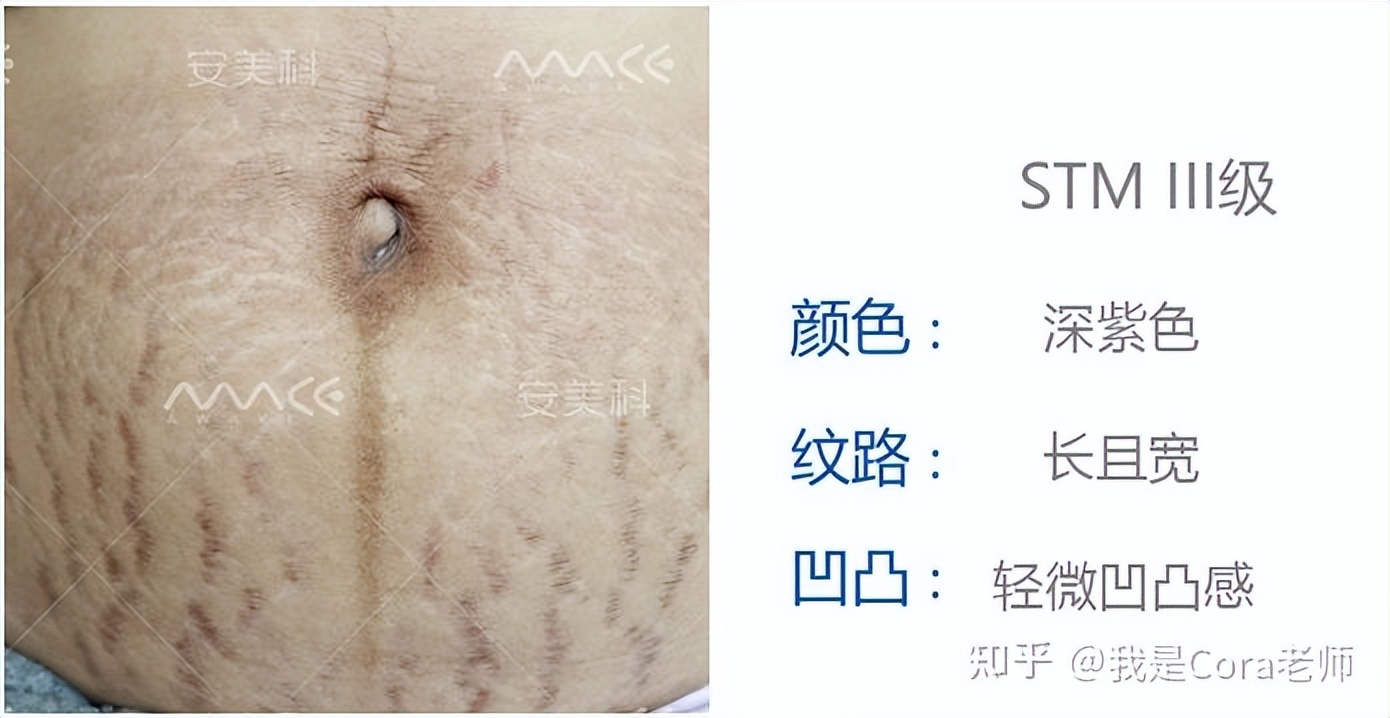 妊娠纹用什么方法可以修复,妊娠纹可以修复吗