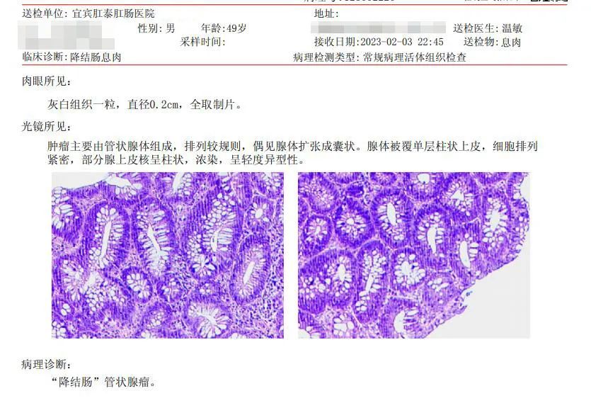 肠镜查出管状腺瘤是怎么回事,肠镜查出管状腺瘤是什么
