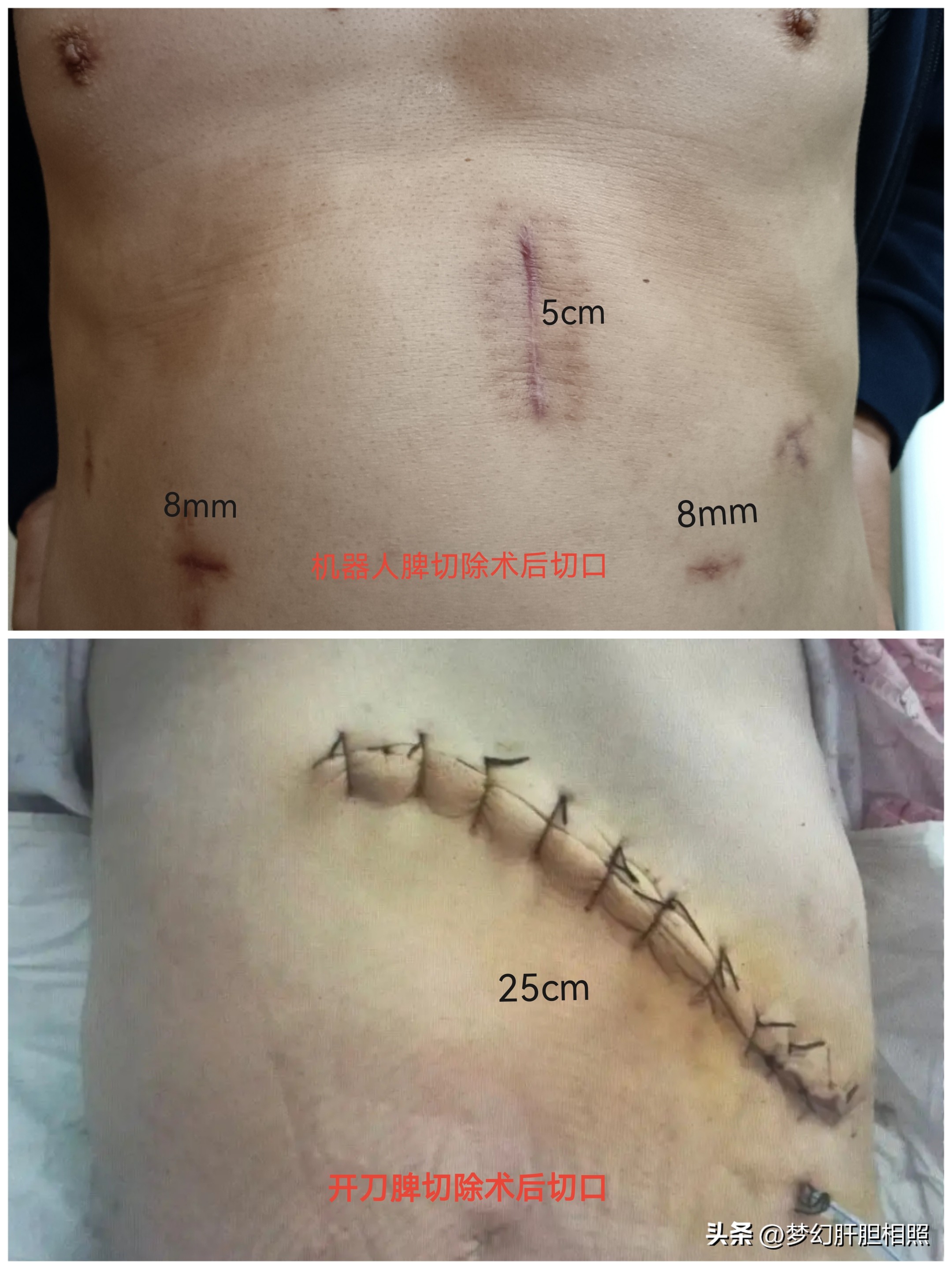 什么是微创手术机器,什么是微创手术是大手术