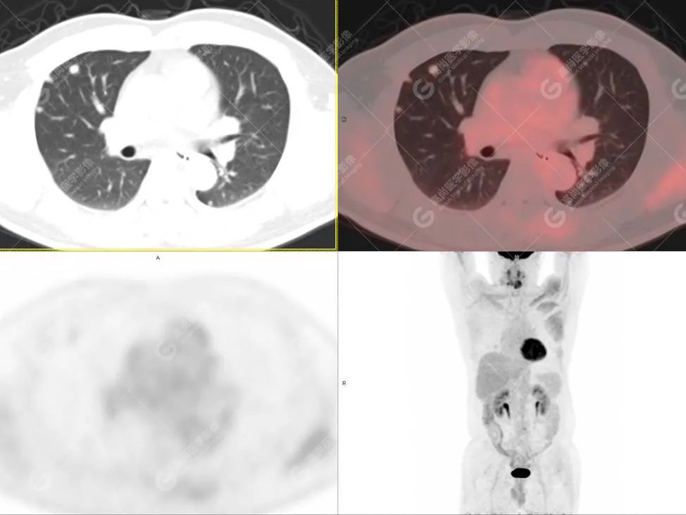 肺部结节确诊是癌如何治疗,肺结节疑似早期恶性肿瘤