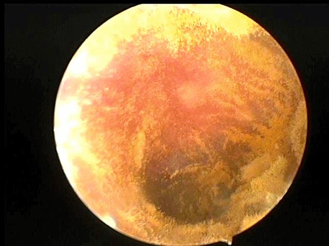 耳朵里面发霉长毛要清除吗,耳朵里长毛发霉了