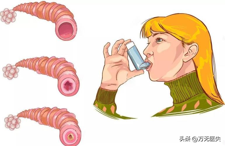 青少年运动后哮喘的治疗方法,儿童哮喘和成人哮喘治疗一样吗