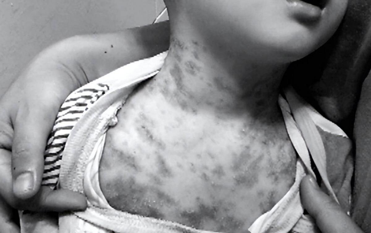 给孩子洗药浴洗出绝症,宝妈带孩子洗药浴染绝症