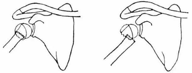 肱骨近端骨折属于几级伤残,肱骨近端骨折康复训练技巧