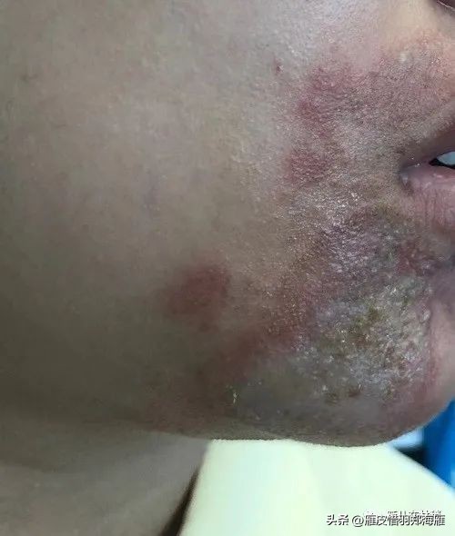 九月初预警：隐翅虫年度盛典，奇怪皮炎频现，教您如何躲着点