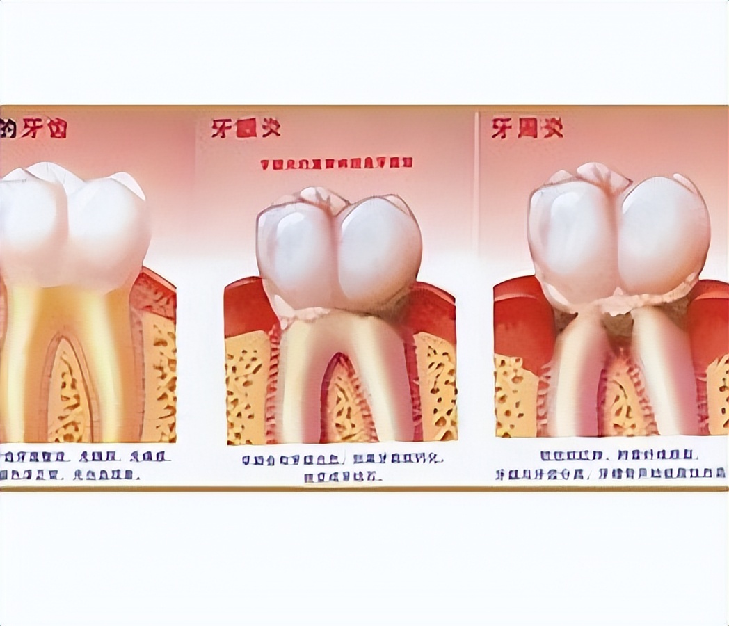 牙周病什么样的,牙周病是什么样的