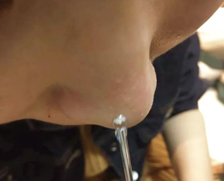 鼻子的黑头跟草莓一样,草莓黑头怎么去除最有效