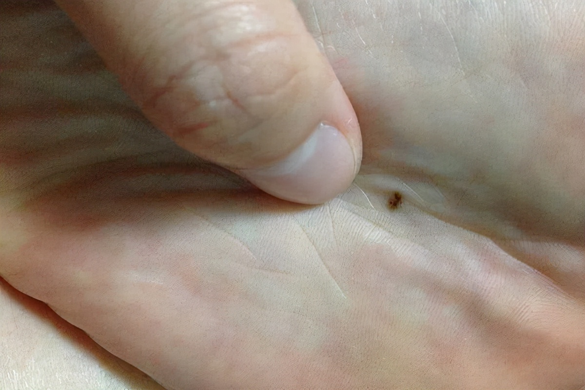 黑斑上长黑痣是不是有癌细胞,身上长黑痣越来越多会是癌细胞吗