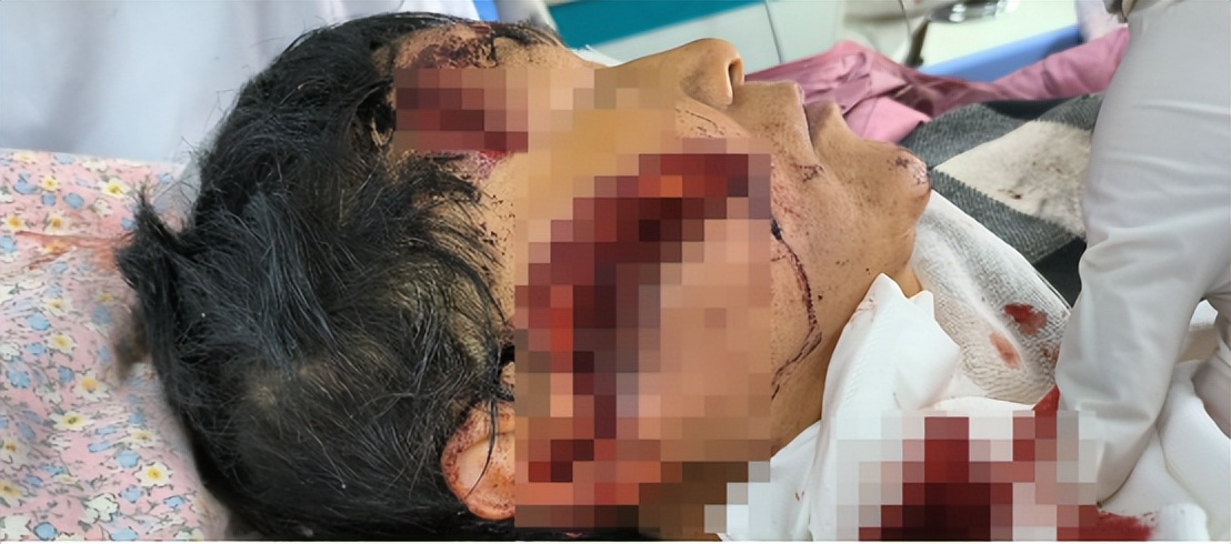 *安泰**市中心医院口腔颌面外科协同多学科成功救治一名突发事件重伤患者