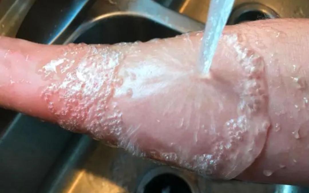 烫伤的紧急处理方法,烫伤紧急处理的第一步是