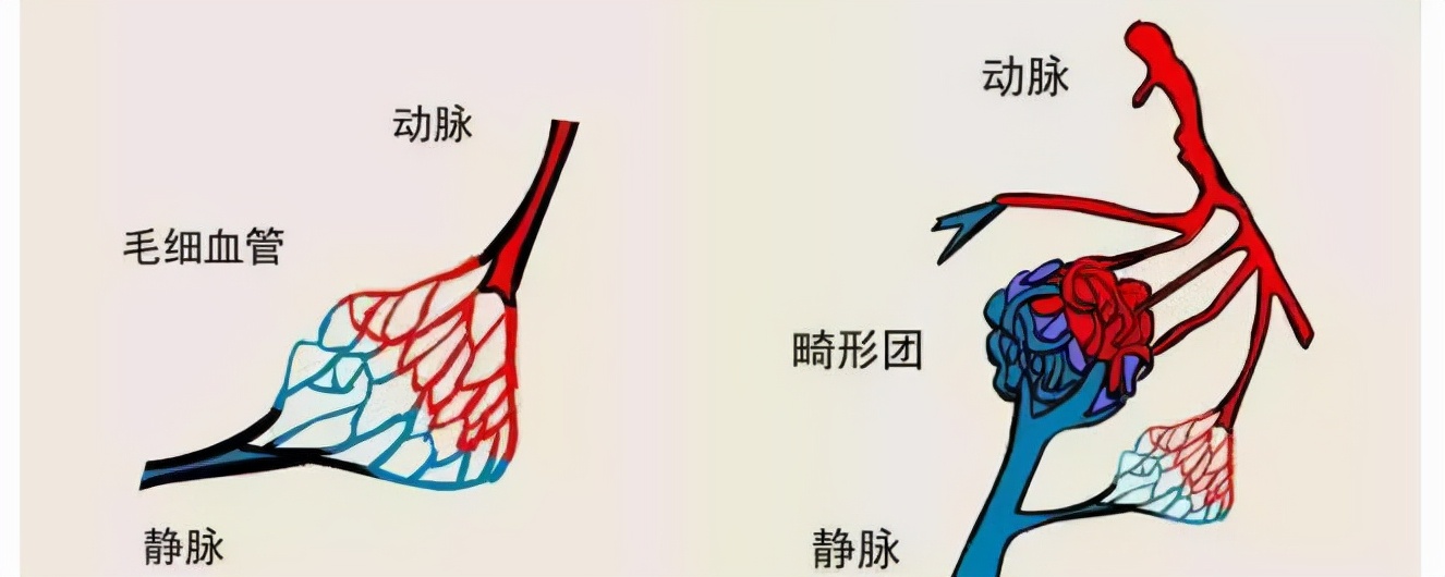 新生儿身上有肿块，当心动静脉畸形