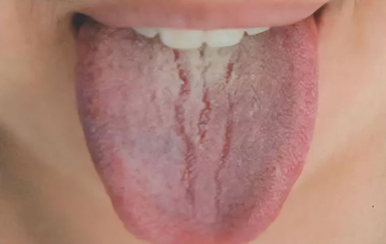 舌头上虚火怎么调理,舌有裂纹中医调理要多久