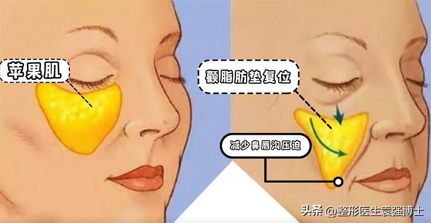 有法令纹千万不要做这三件事,年纪轻轻就有法令纹该怎样去解决