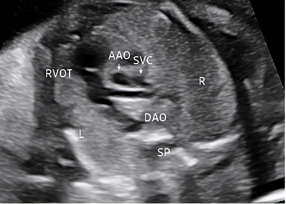孕晚期i级产前超声检查是什么,孕中期超声产前检查