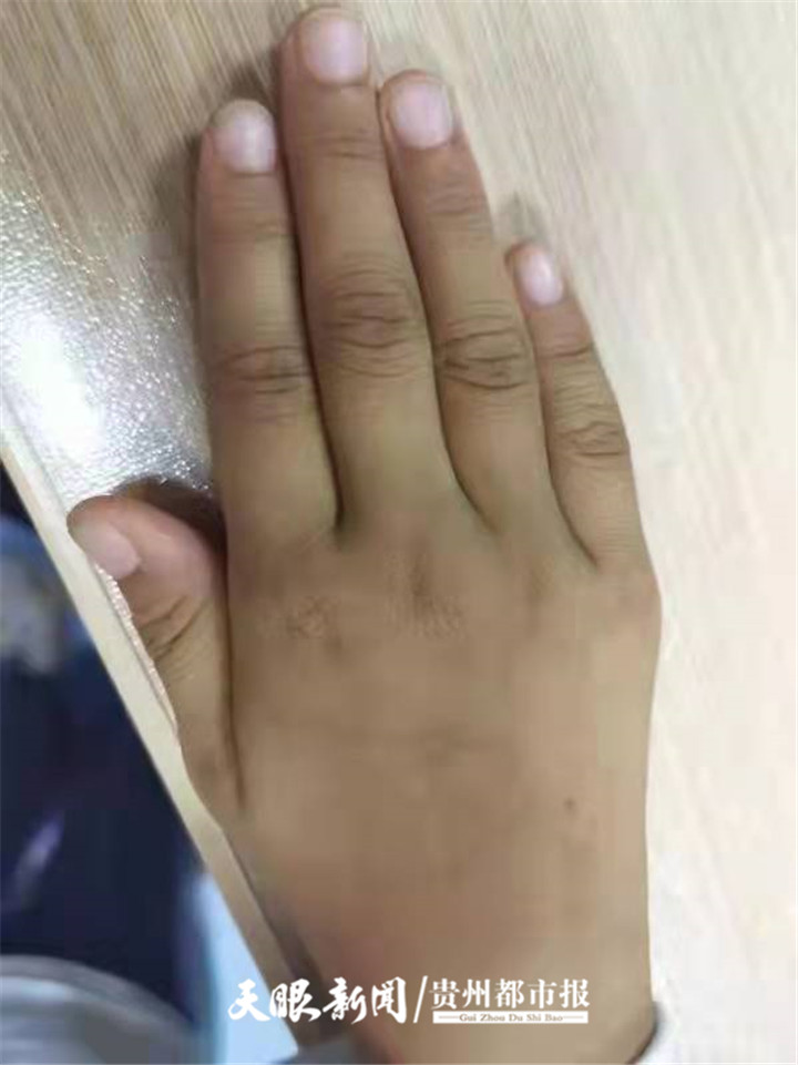 12岁小孩风湿关节炎,儿童医院风湿免疫科好吗