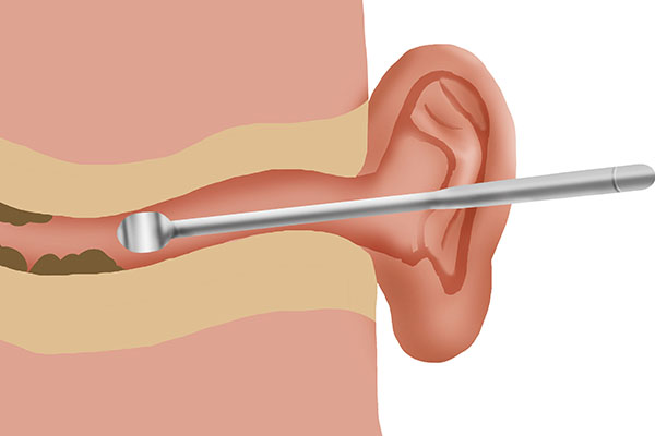 干耳屎会变成油耳朵吗,耳朵每天都有耳屎是干耳还是油耳