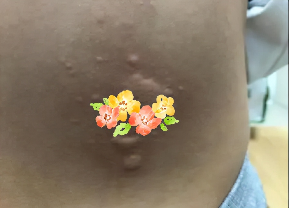 孩子晚上起皮疹,孩子一觉醒来全身都肿了