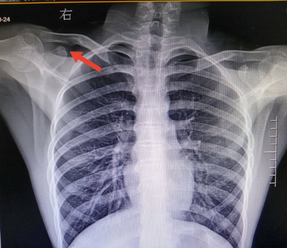 熬夜玩游戏，少年频繁癫痫发作、关节脱臼
