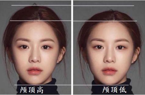 颅顶低发际线高怎么办,发际线高颅顶低怎么改善