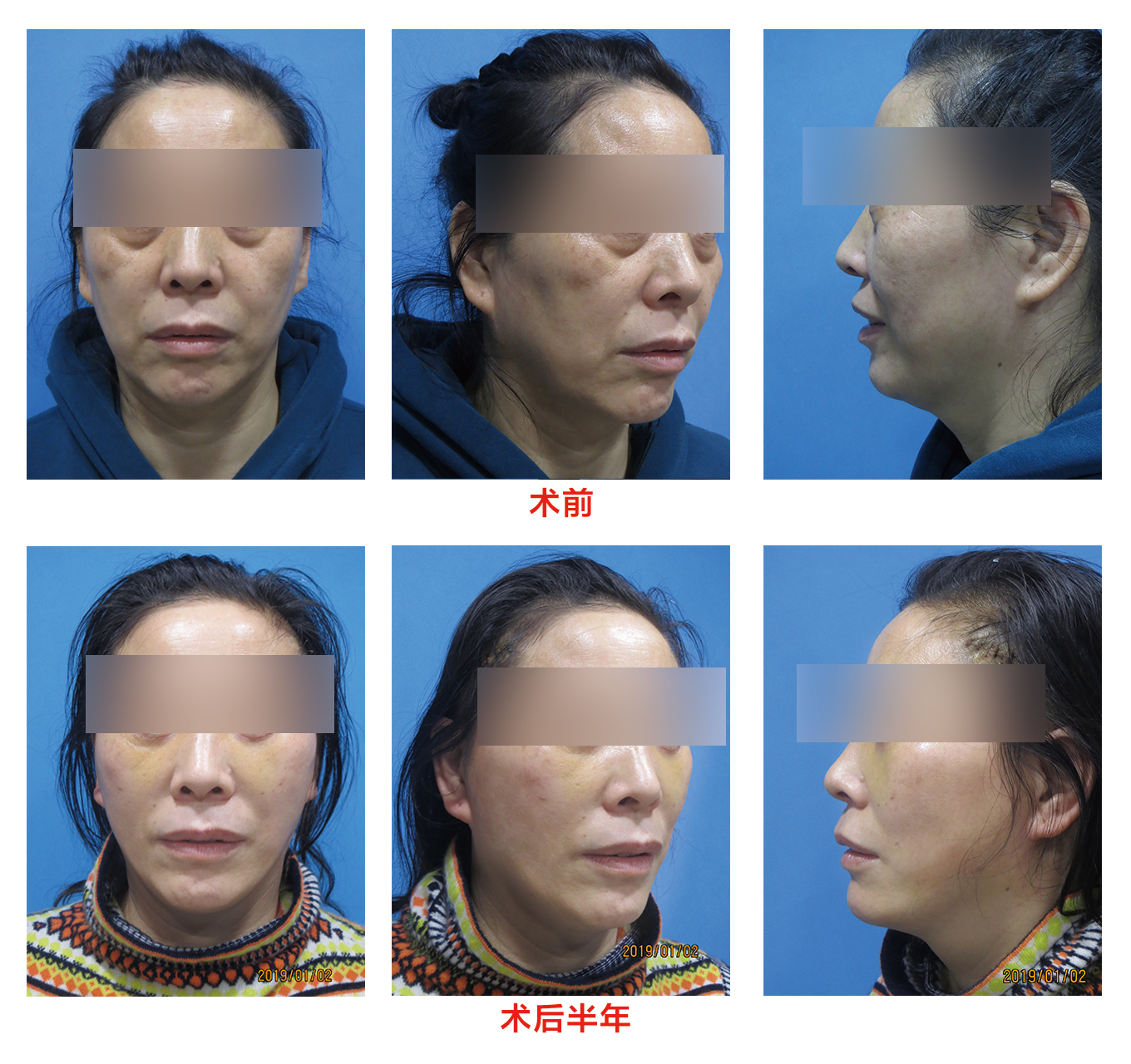 面部提升整形失败如何修复,面部提升年轻化术真实案例