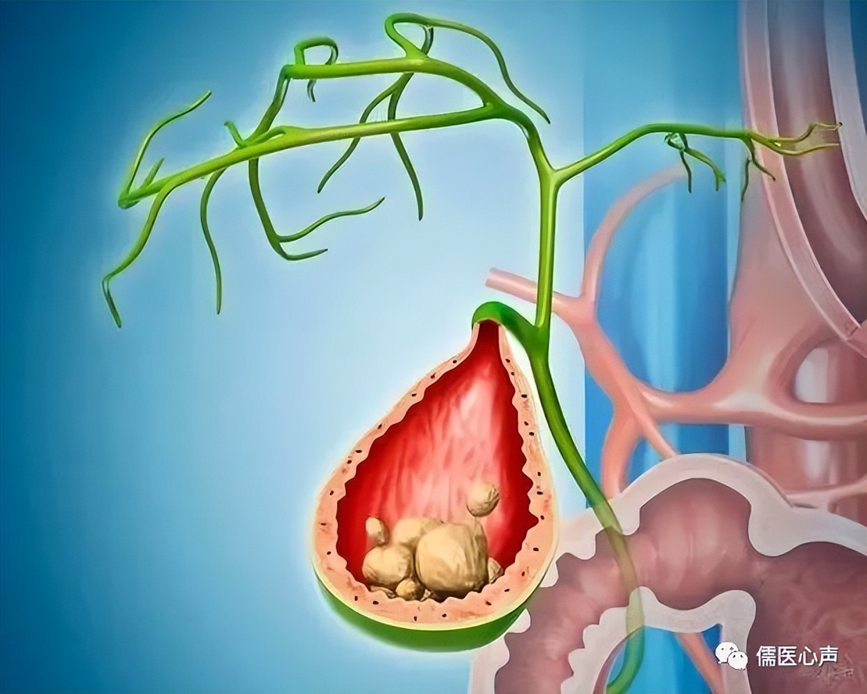 胆绞痛持续多长时间,胆绞痛反复发作怎么办