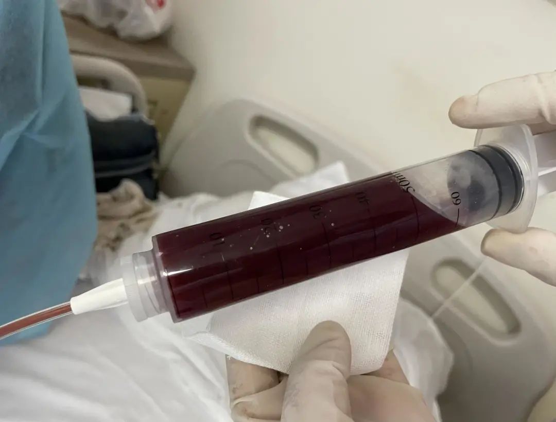 免疫缺陷病会并发什么病,什么是免疫缺陷肺部感染