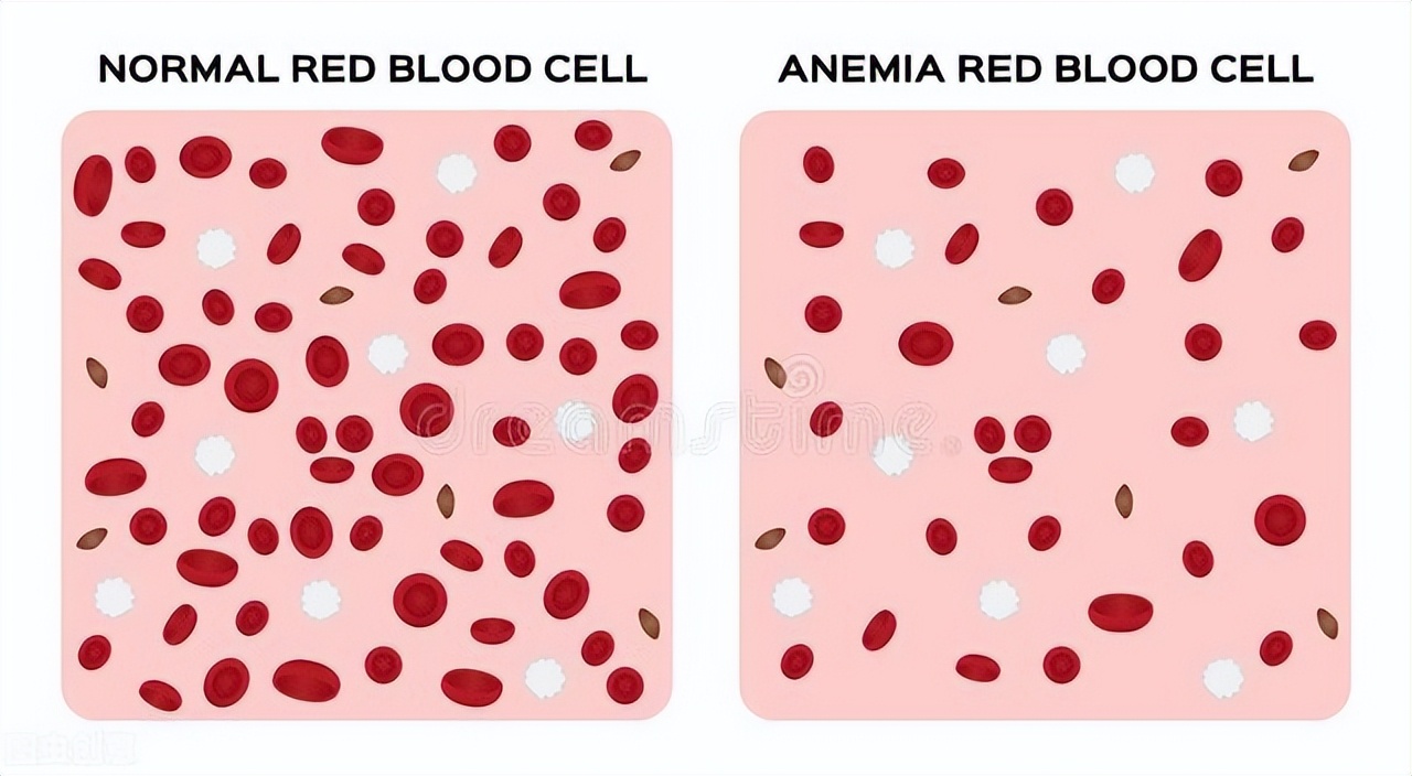 中度贫血怎么才能快速造血,严重贫血是不会造血了吗