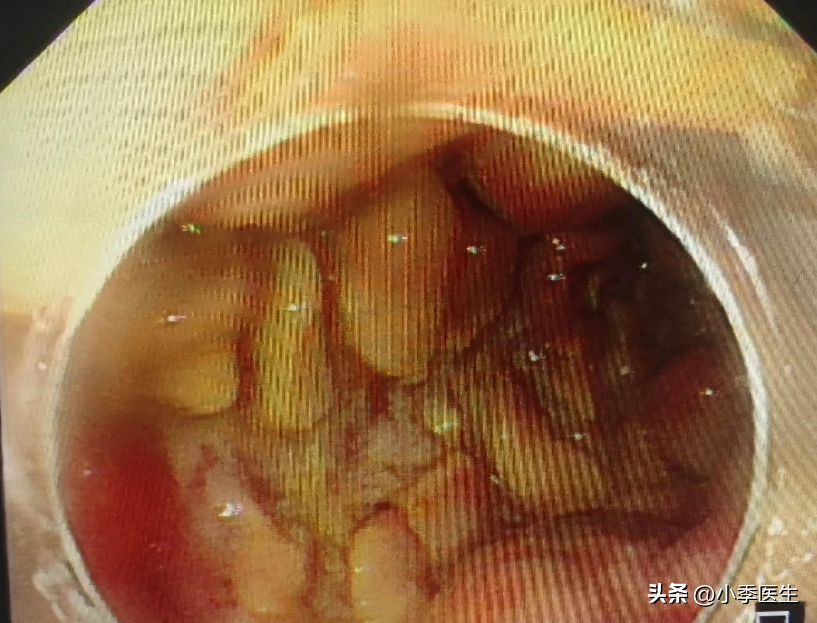腹痛便血颜色是鲜红色,腹痛便血柏油便