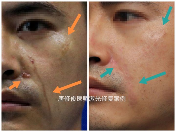 点阵激光后的伤口要几天愈合,伤口做点阵激光治疗