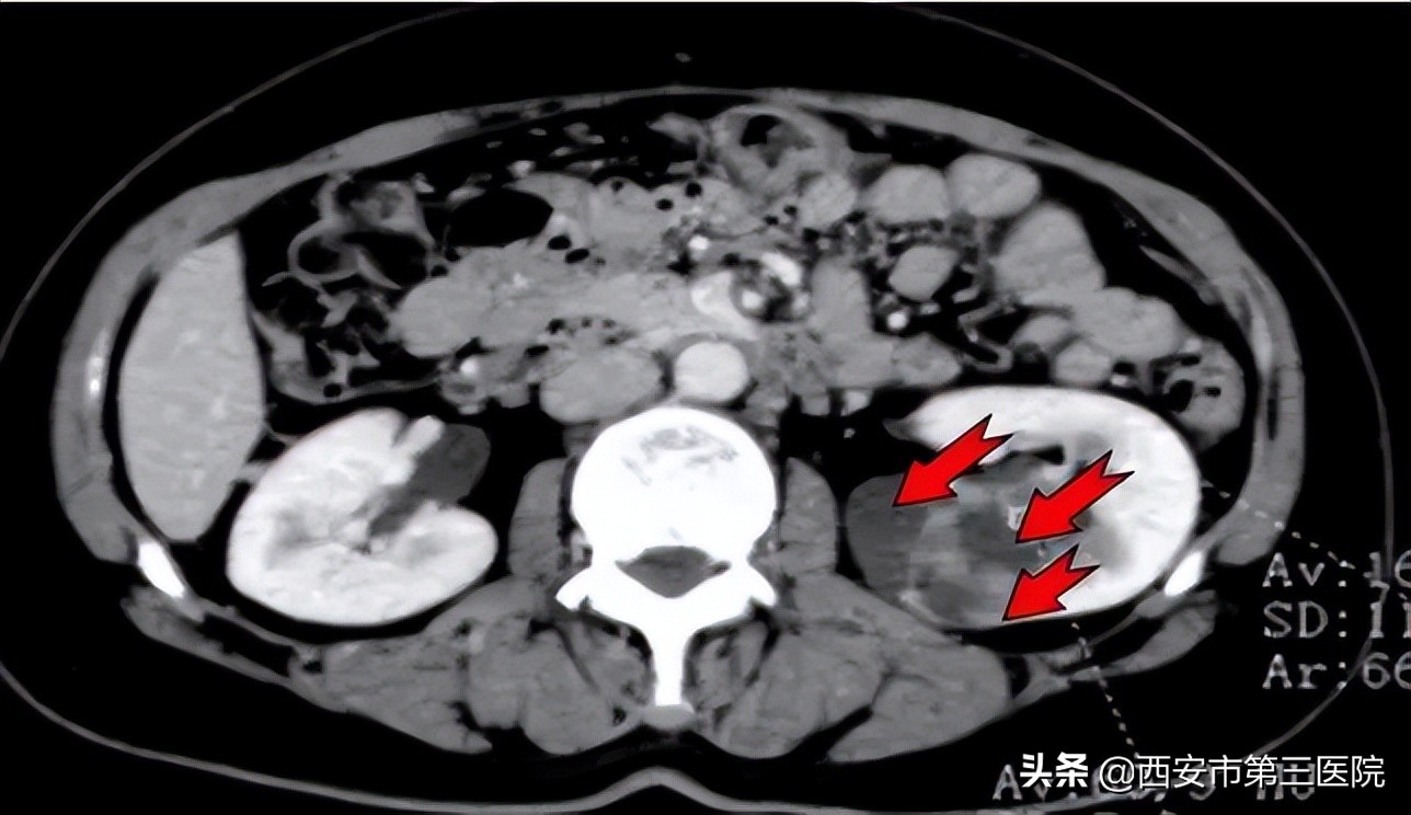 肾囊肿跟肿瘤有什么区别,囊肿在检查过程中破了会怎样