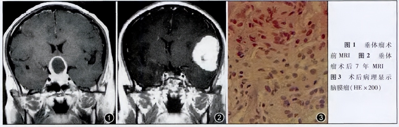脑膜瘤放疗有哪些副作用,脑瘤放疗有癫痫的潜在并发症
