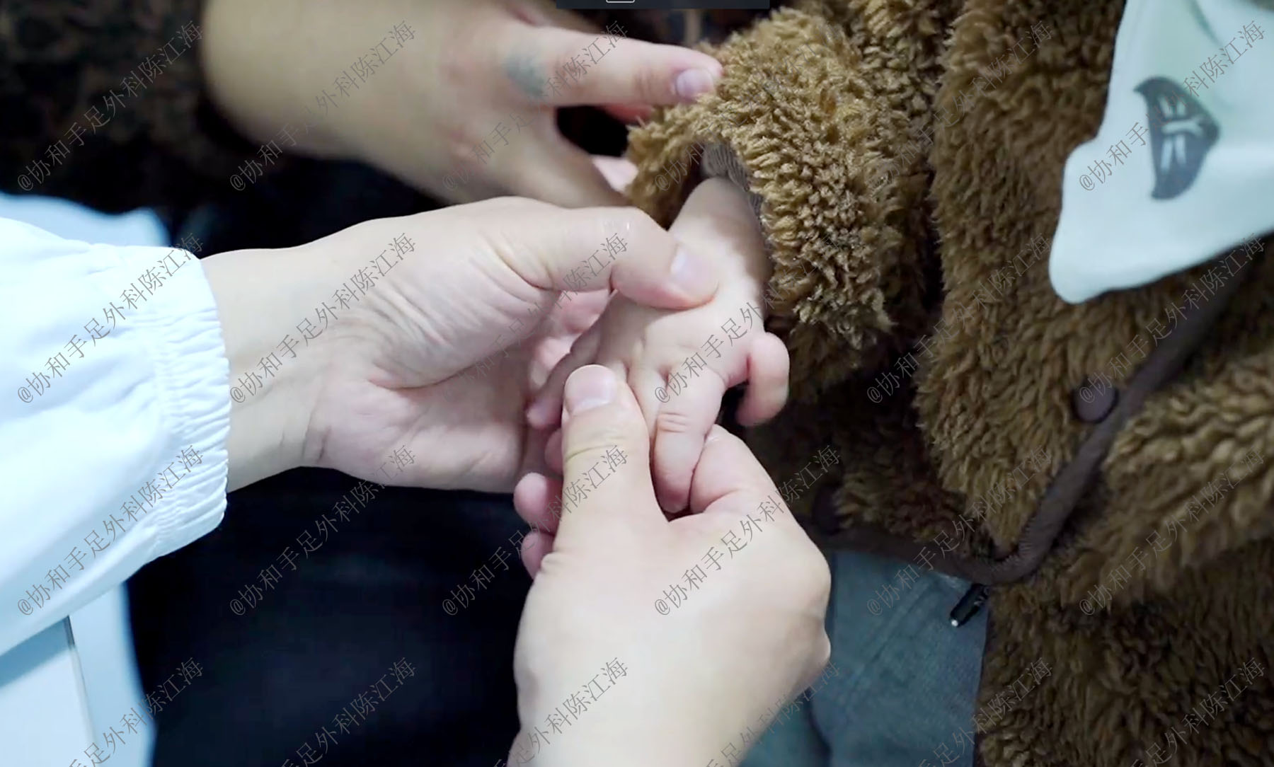 漂浮趾的治疗,拇指漂浮指的治疗方案